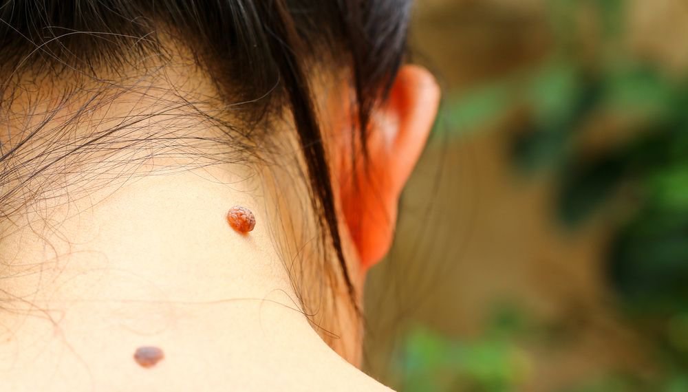 How Long Does It Take For A Mole Removal Scar To Fade Quora