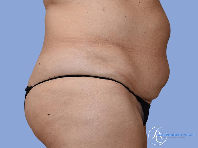 Abdominoplasty before & after photo