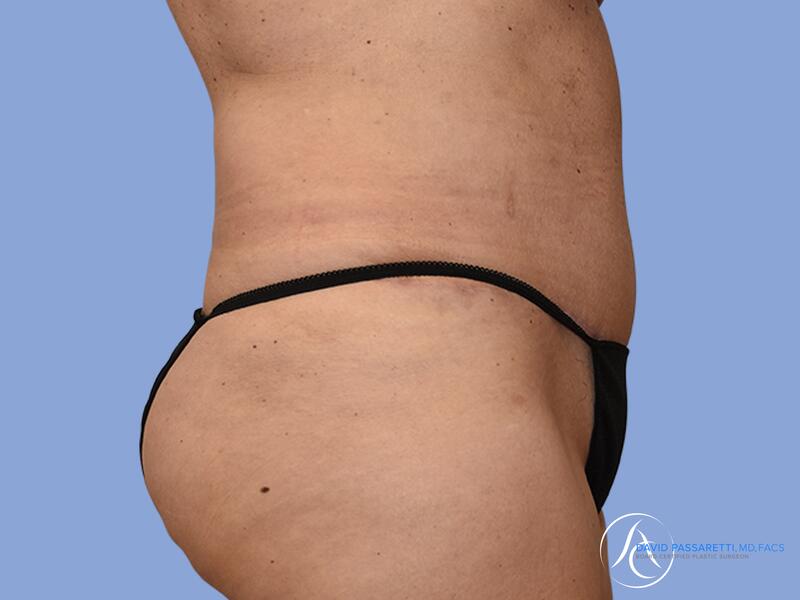 Abdominoplasty before & after photo