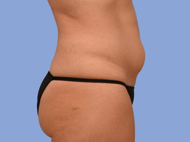 Abdominoplasty before & after photo