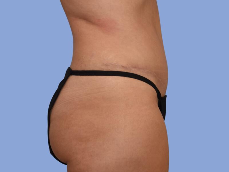 Abdominoplasty before & after photo