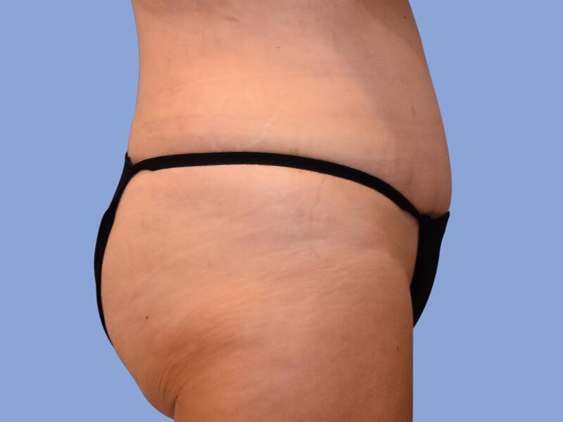 Abdominoplasty before & after photo