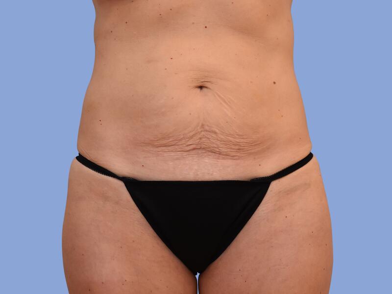 Abdominoplasty before & after photo