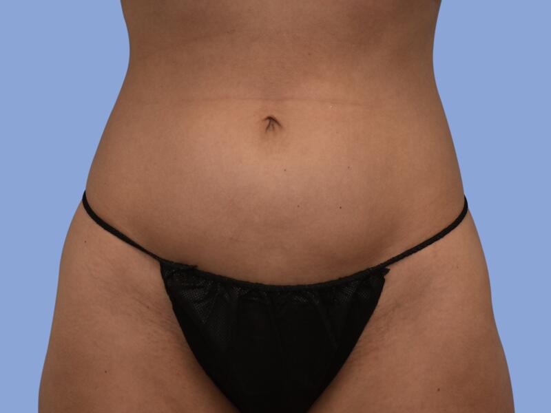 Liposuction before & after photo