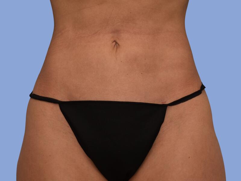 Liposuction before & after photo