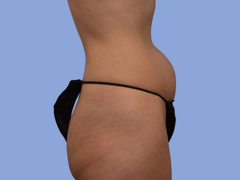 Liposuction before & after photo