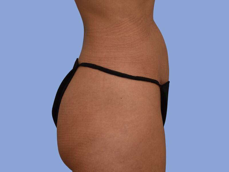 Liposuction before & after photo