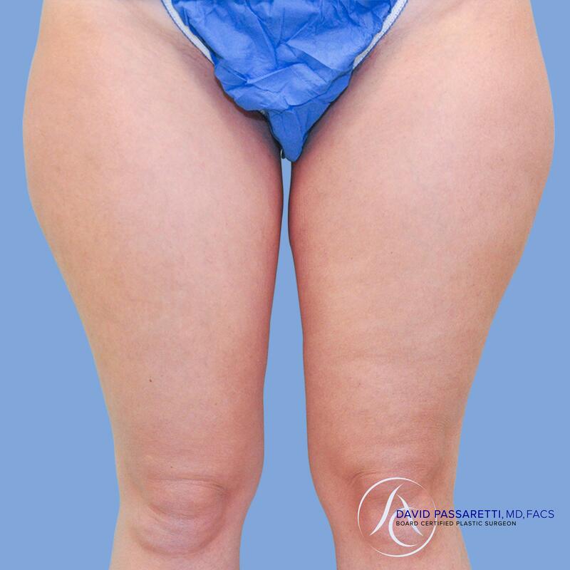 Liposuction before & after photo