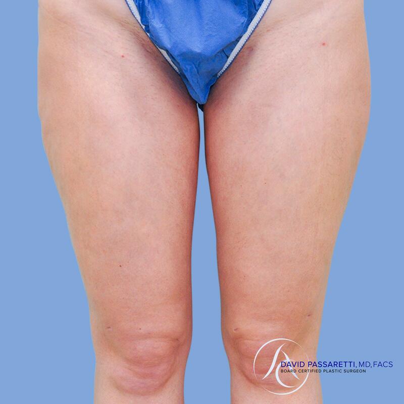 Liposuction before & after photo