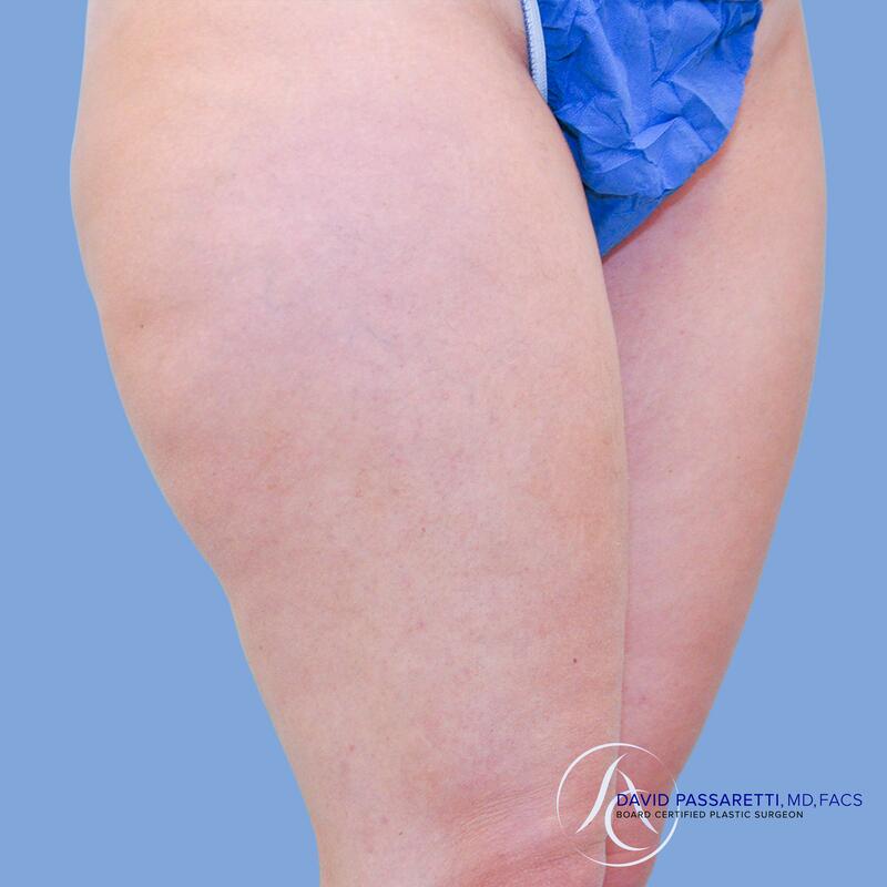 Liposuction before & after photo