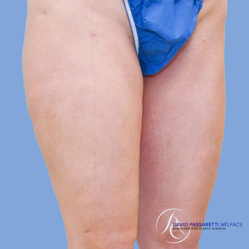 Liposuction before & after photo