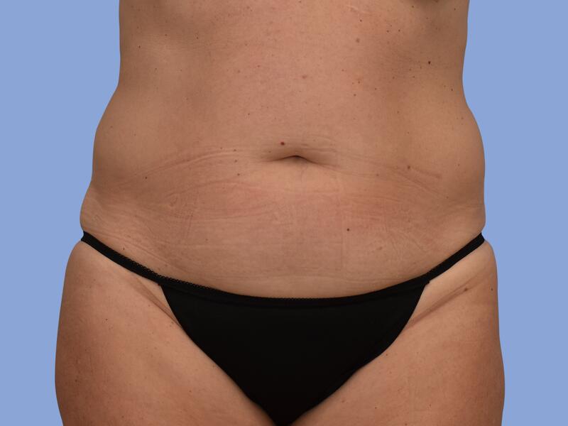 Liposuction before & after photo