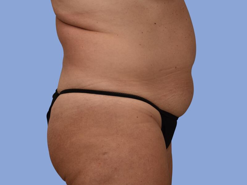 Liposuction before & after photo