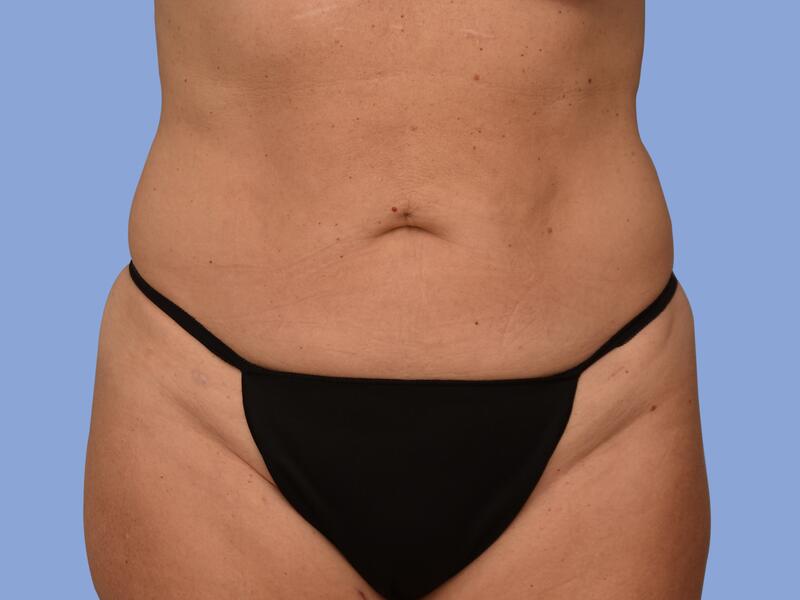 Liposuction before & after photo