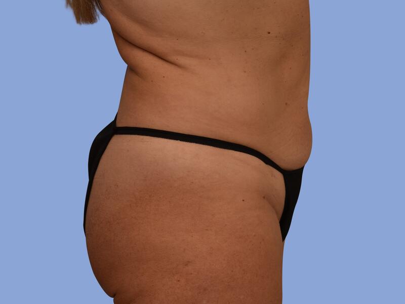 Liposuction before & after photo