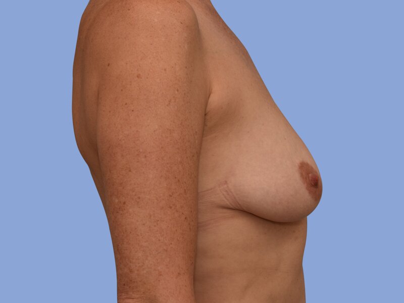 Breast augmentation before & after photo