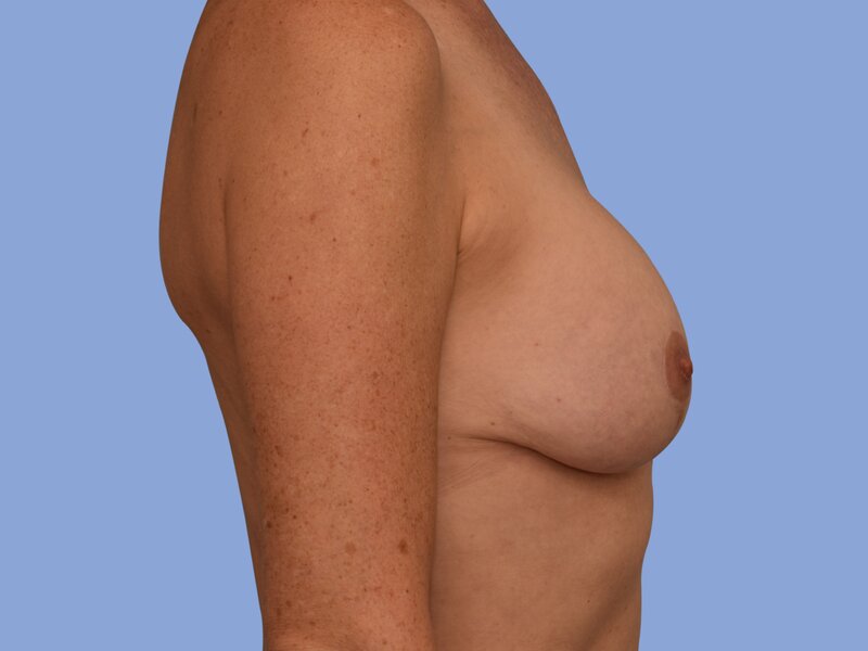 Breast augmentation before & after photo