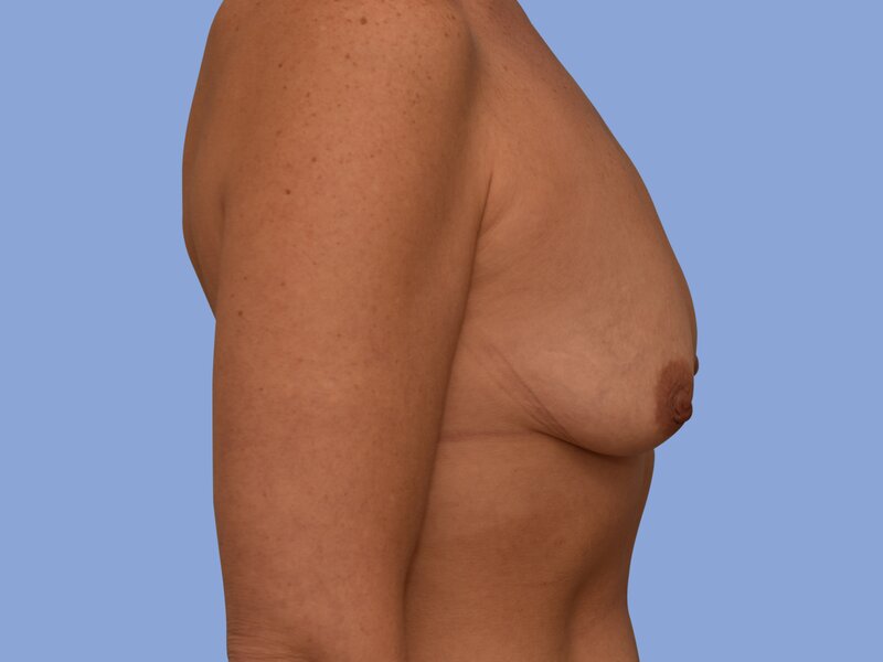 Breast augmentation before & after photo