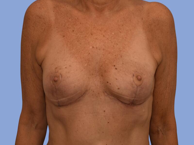 Breast lift before & after photo