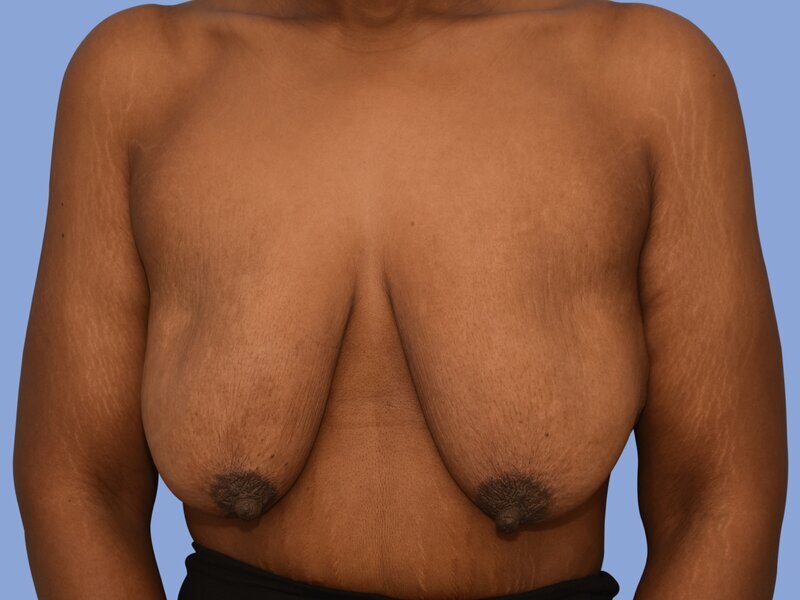 Breast lift before & after photo