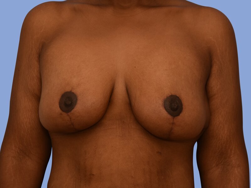 Breast lift before & after photo