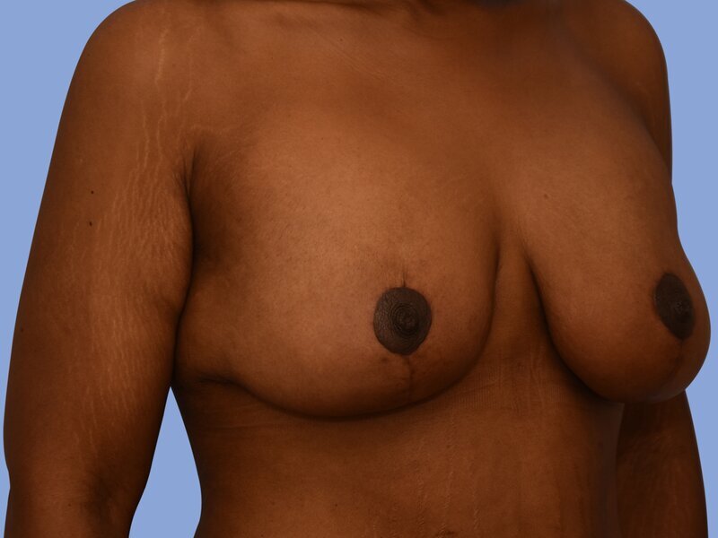 Breast lift before & after photo