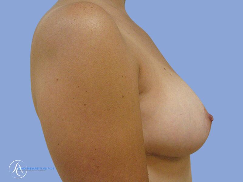 Breast reduction before & after photo