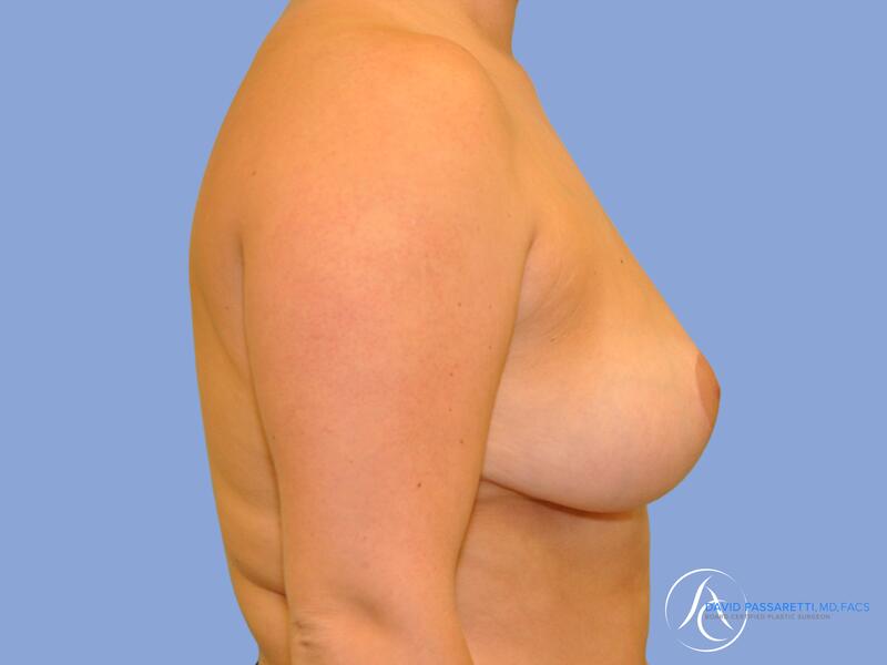 Breast reduction before & after photo