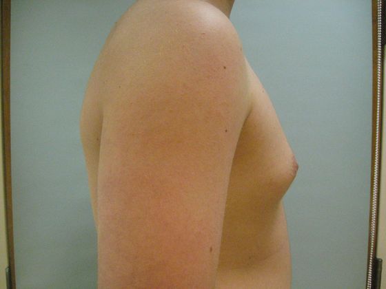 https://www.davidpassarettimd.com/gallery/breast/male-breast-reduction/01/03.jpg