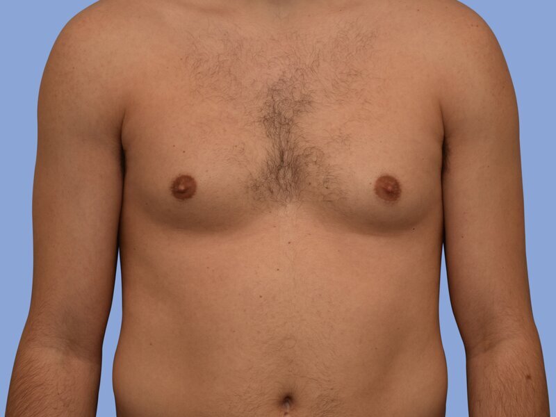 Male breast reduction before & after photo