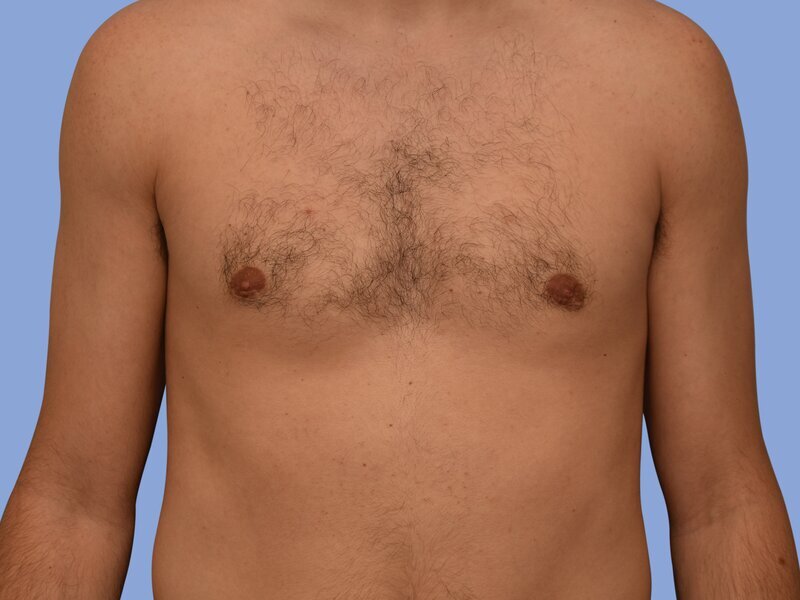 Male breast reduction before & after photo