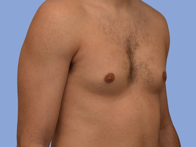 Male breast reduction before & after photo