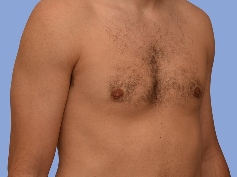 Male breast reduction before & after photo