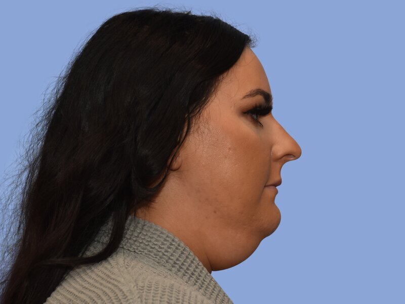 Chin liposuction before & after photo