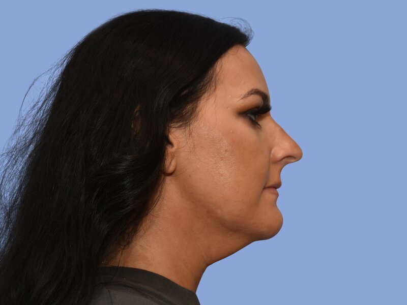 Chin liposuction before & after photo