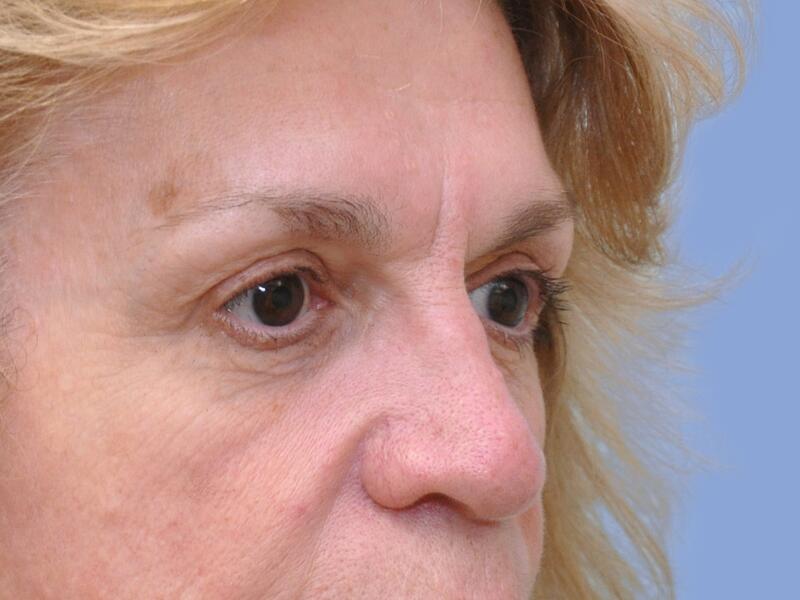 Eyelid surgery before & after photo