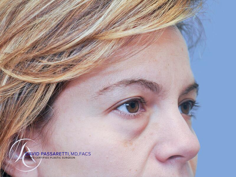 Eyelid surgery before & after photo