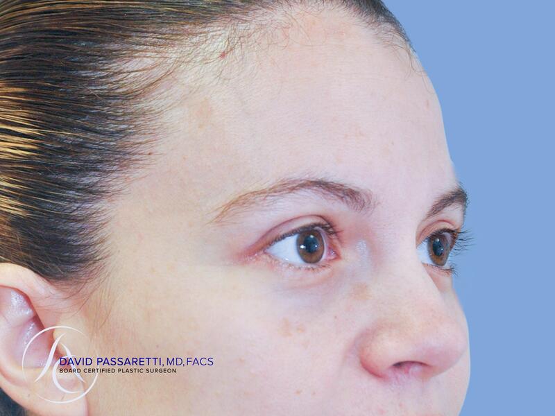 Eyelid surgery before & after photo