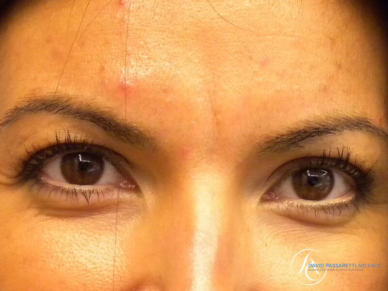 Eyelid surgery before & after photo