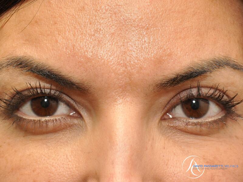 Eyelid surgery before & after photo