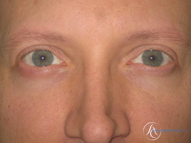 Eyelid surgery before & after photo