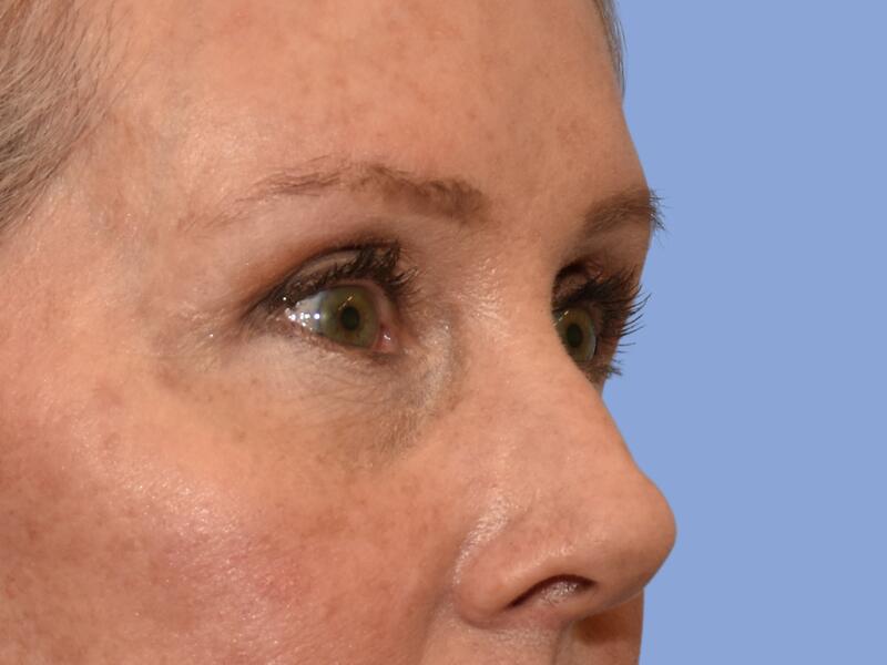 Eyelid surgery before & after photo