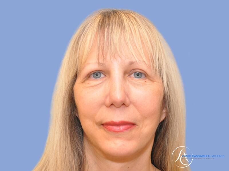 Facelift before & after photo