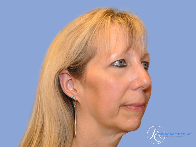 Facelift before & after photo