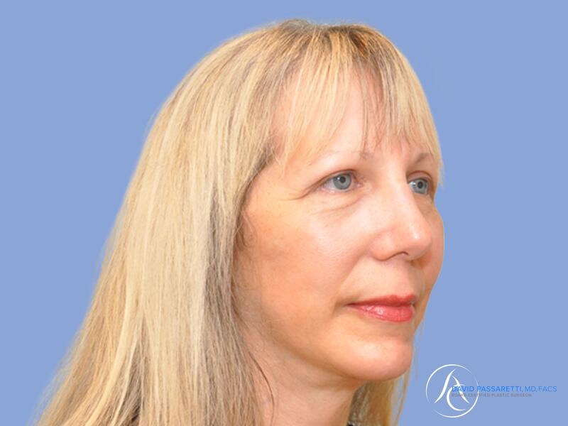 Facelift before & after photo