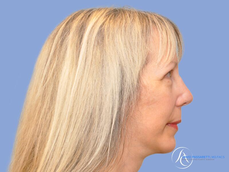 Facelift before & after photo