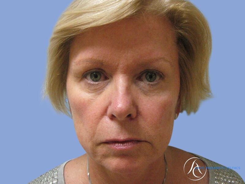 Facelift before & after photo