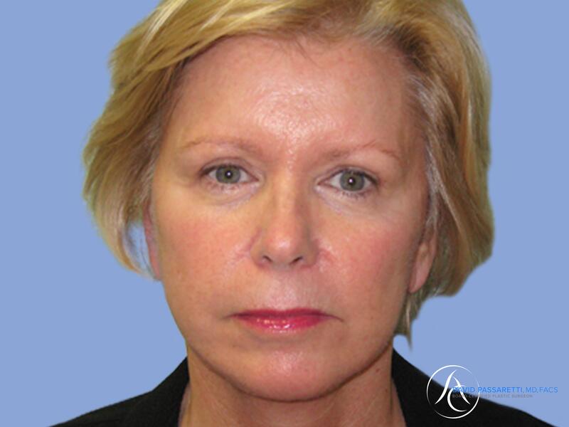 Facelift before & after photo