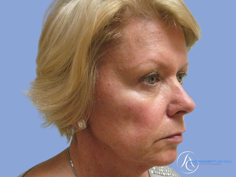 Facelift before & after photo