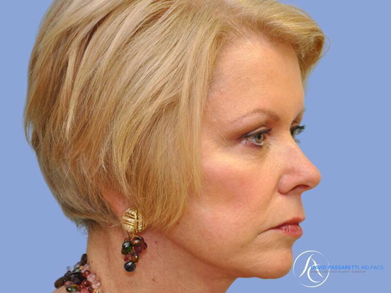 Facelift before & after photo